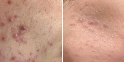 Acne ativa com Nd:YAP ProDeep®