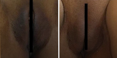 Clareamento íntimo com LASER Q-Switched e Er:YAG