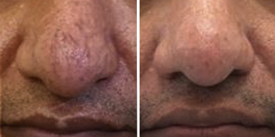 Combinação de LongPulse®, ProDeep®, DualMode® e IPL-Sq® para o tratamento de rinofima
