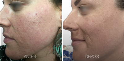 ProDeep® + handPICO® na mesma sessão
