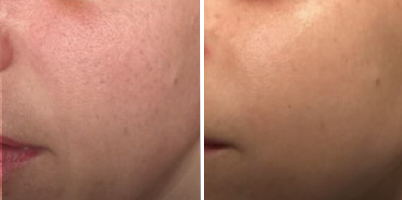 Antes e Depois