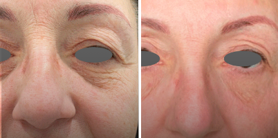 DualMode® Er:YAG para resurfacing de toda a face e flacidez das pálpebras