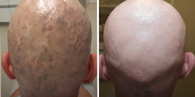 Líquen plano pilar e tatuagem em couro cabeludo com IPL-Sq® e Q-Switched