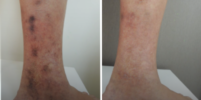 LASER Q-Switched no tratamento de dermatite ocre após doença venosa