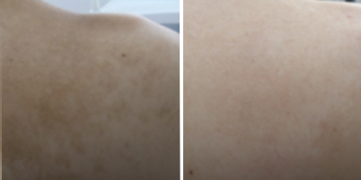 LASER Q-Switched para tratamento de nevus em dorso