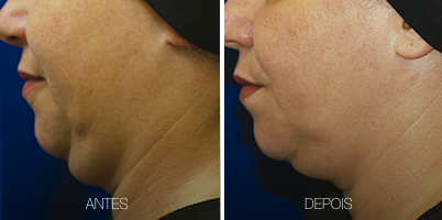 LASER tightening 1
