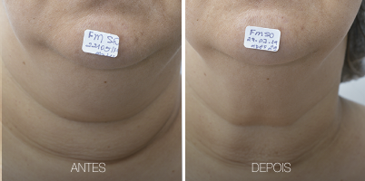 LASER tightening 3