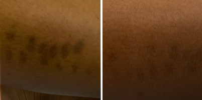 Laser em picosegundos – handPICO® para hipercromia em membro inferior (fototipo VI)