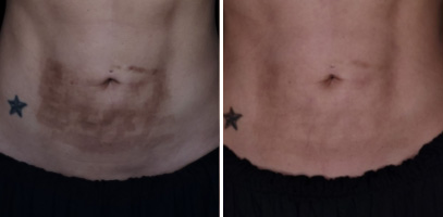Before and after