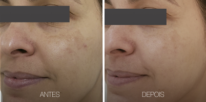 Melasma com rejuvenescimento
