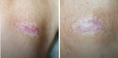 Queloide sintomático tratado com IPL-Sq® e associações