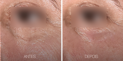 Rejuvenescimento da área dos olhos com TrueLift®