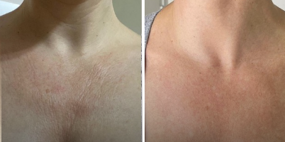 Rejuvenescimento de colo com IPL-Sq® e Er:YAG (DualMode®)