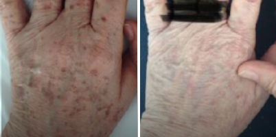Rejuvenescimento de mãos com IPL-Sq® e Er:YAG