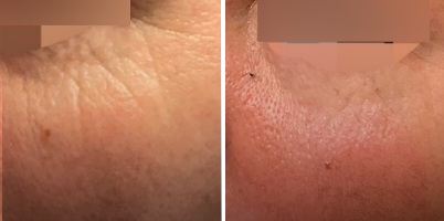 Rejuvenescimento facial e periorbital com laser não ablativo ProDeep®