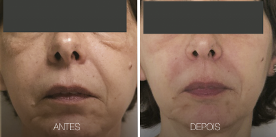 Rejuvenescimento sem downtime 1