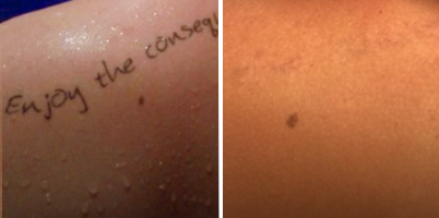 Remoção de tatuagem com LASER Q-Switched