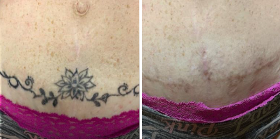 Remoção de tatuagem com a combinação de ACROMA-QS® e DualMode®