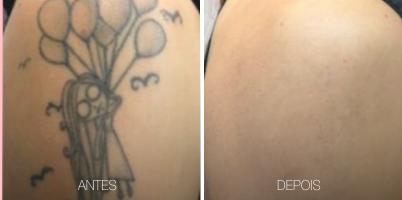 Remoção de tatuagem com o LASER handPICO®