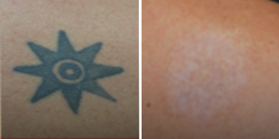 Remoção de tatuagem combinando LASER Q-Switched e SCULPTOR CO2®