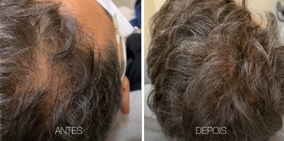Tratamento de Alopecia com ProDeep®