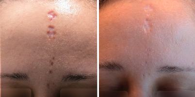 Tratamento de Cicatriz pós Herpes Zóster com laser Er:YAG.