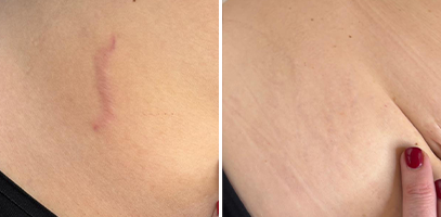 Tratamento de Estrias com laser não ablativo e laser ablativo
