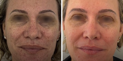 Tratamento de telangiectasias faciais com IPL-Sq® e LongPulse®