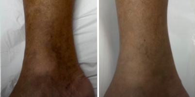 Tratamento de Hiperpigmentação Pós-Inflamatória após farmacodermia