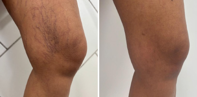 Treatment of Vascular Lesions in skin phototype IV