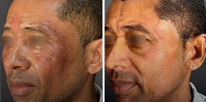 Tratamento de Melasma em fototipo V com ACROMA-QS®