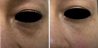 Tratamento de Olheiras com laser em picossegundos