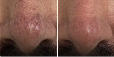 Tratamento de Telangiectasias nasais com sessão única utilizando IPL-Sq®