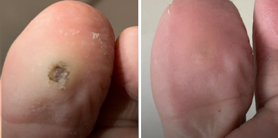 Tratamento de Verruga Plantar com Laser Nd:YAG 1.064 nm