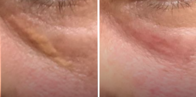 Tratamento de Xantelasma com ACROMA-QS®