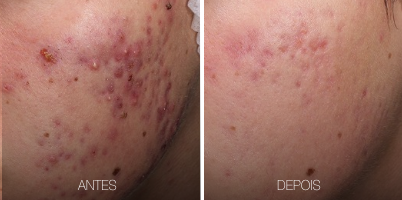 Tratamento de Acne com ProDeep®