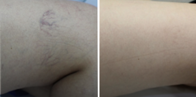 Tratamento de aranhas vasculares com LongPulse®