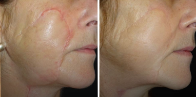 Cicatriz facial pós-operatória com Nd:YAP ProDeep®