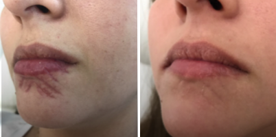 Tratamento de cicatriz traumática utilizando ProDeep®
