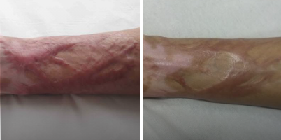 Tratamento de cicatrizes de queimadura com IPL-Sq® e ProDeep®