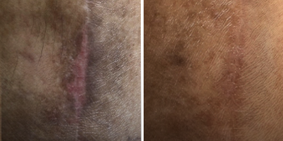 Dermatite ocre e cicatriz pós-cirurgia vascular com ACROMA-QS® e handPICO®