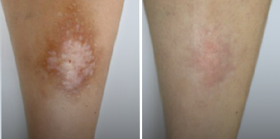 Tratamento de esclerodermia localizada com IPL-Sq®