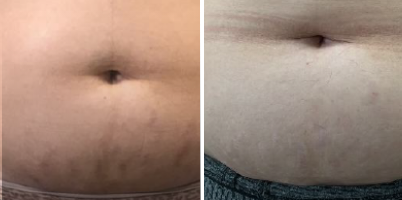 Tratamento de estrias com IPL-Sq® e Nd:YAP