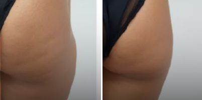 Estrias e celulite com infravermelho (IntenseIR) e Er:YAG (DualMode®)