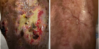 Tratamento de ferida com LongPulse®️