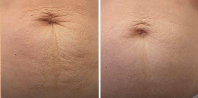 Tratamento de flacidez e estrias no abdômen com ProDeep® (fracionado não ablativo)