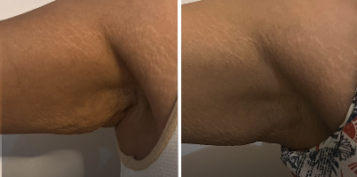 Flacidez nos braços em uma sessão com ProDeep® 1340nm