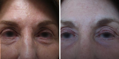 Tratamento de flacidez palpebral com a DualMode®