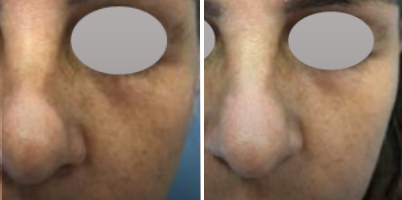 Tratamento de flacidez palpebral com Er:YAG (DualMode®)