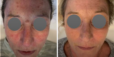 Tratamento de fotoenvelhecimento em face com IPL-Sq®